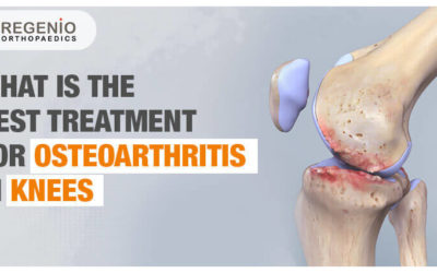 Best Treatment for Osteoarthritis in the Knees?