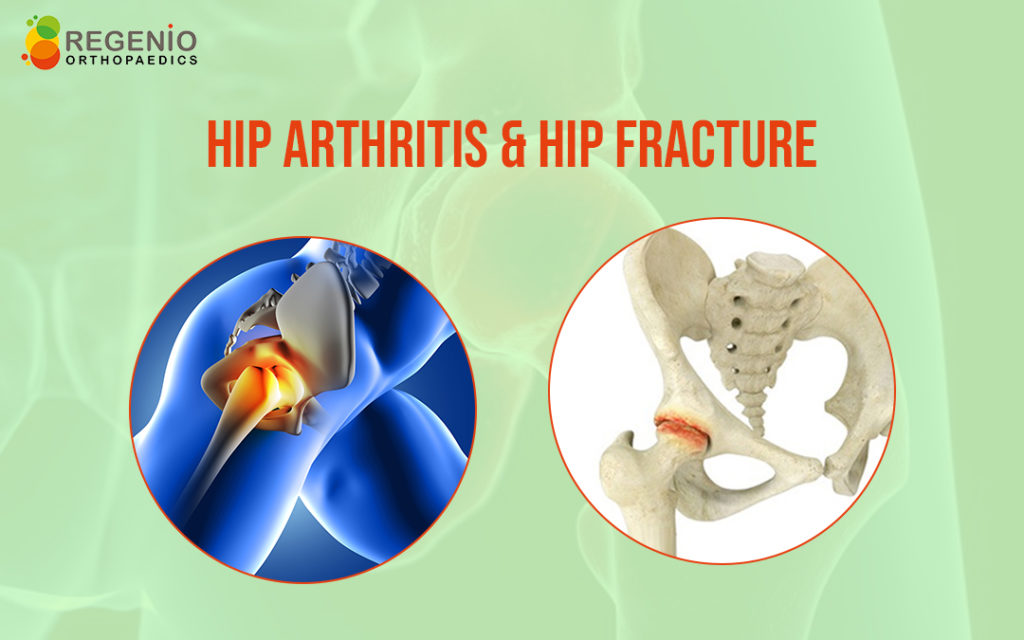 Hip Arthritis & Hip Fracture