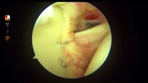After Labral