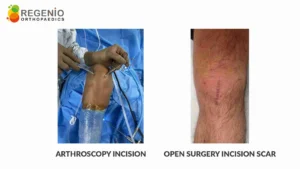 Arthroscopy Incision