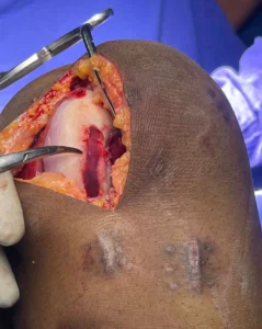 After Cartilage Transplantation