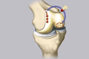 Cartilage Transplantation