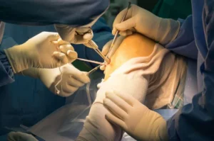 Knee Arthroscopy