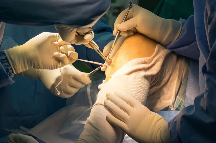 Knee Arthroscopy