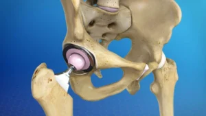 Bone