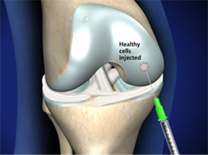 Knee Cartilage Transplant treatment